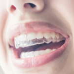 Straighten your Teeth and Smile more with Invisalign