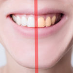Beyond the Enamel: The Benefits of Teeth Whitening Kits